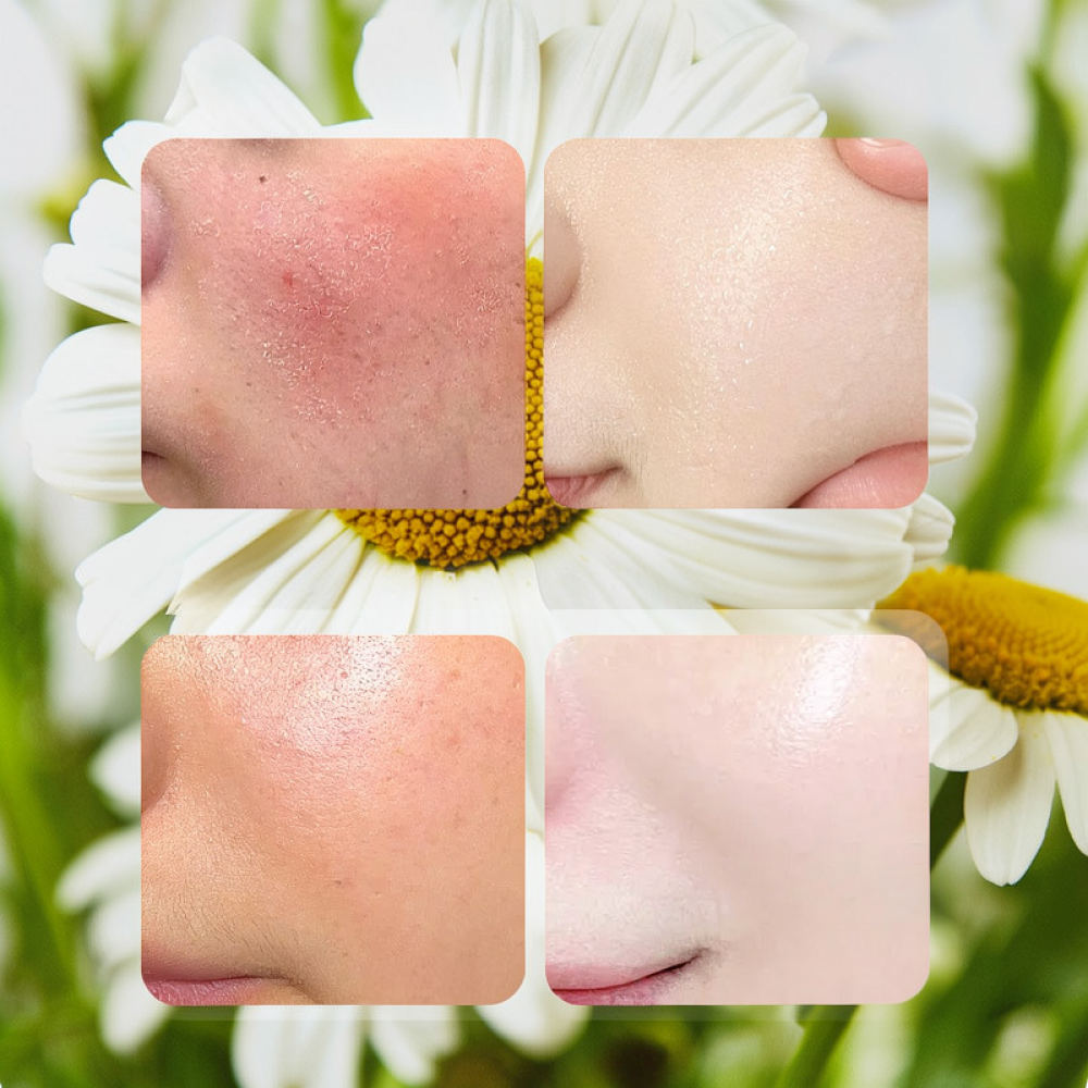 Für Fykly Rose VC Kamille B5 V – Face Mask Skincare Bewertung und Preis